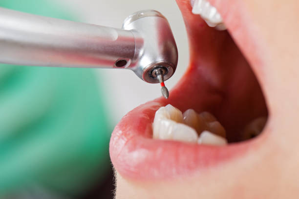Best Emergency Root Canal Treatment in Ricardo, TX